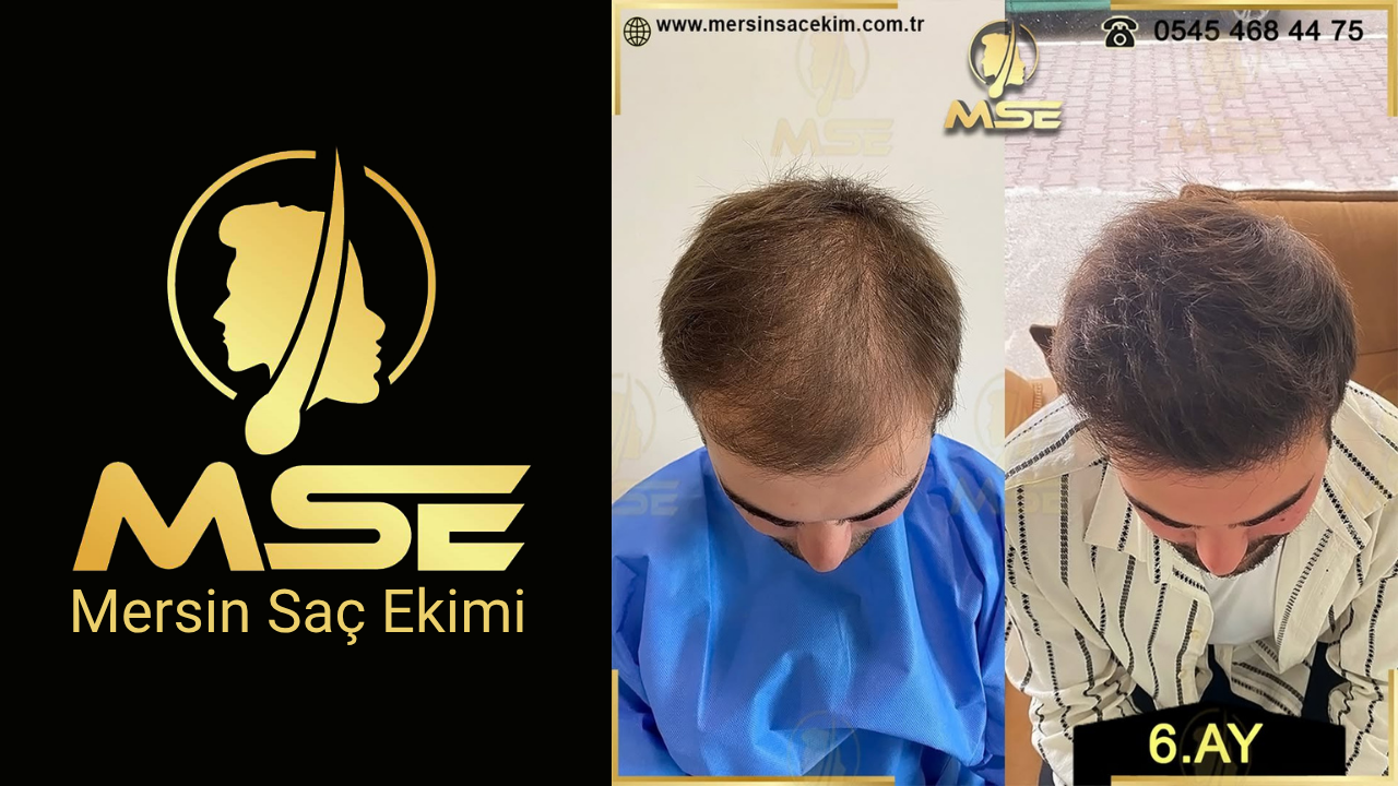 MERSİN SAÇ EKİMİ